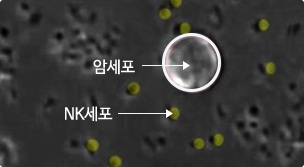 활성도가 낮은 NK세포 숫자는 많으나 암세포를 제거하지 못함